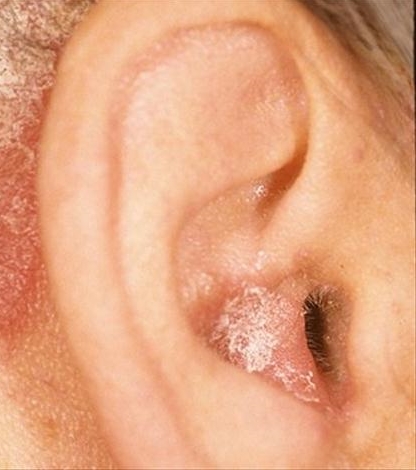 persistant inner ear itch